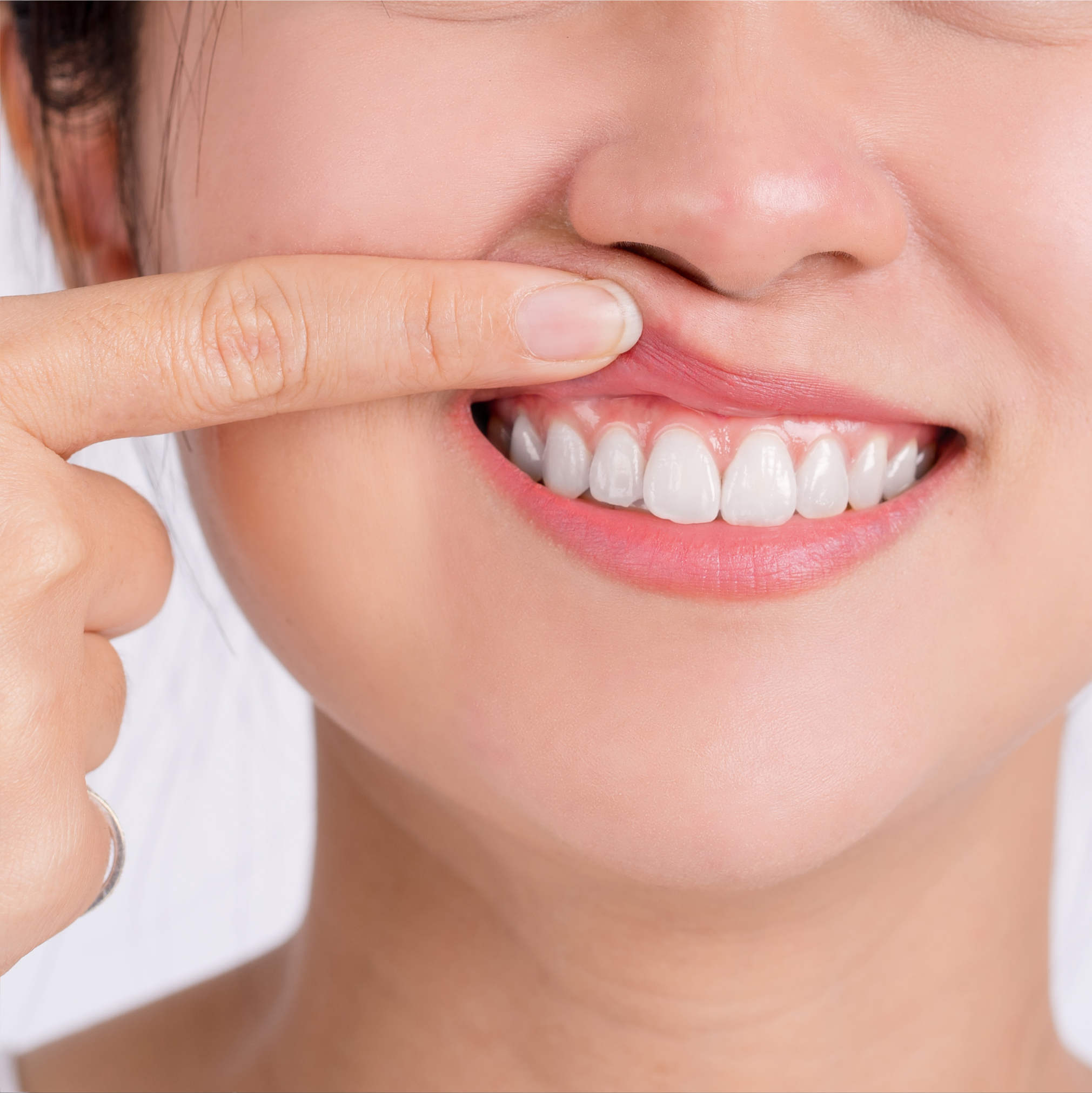 Periodontal (Gum) Disease: Symptoms, Causes & Treatment