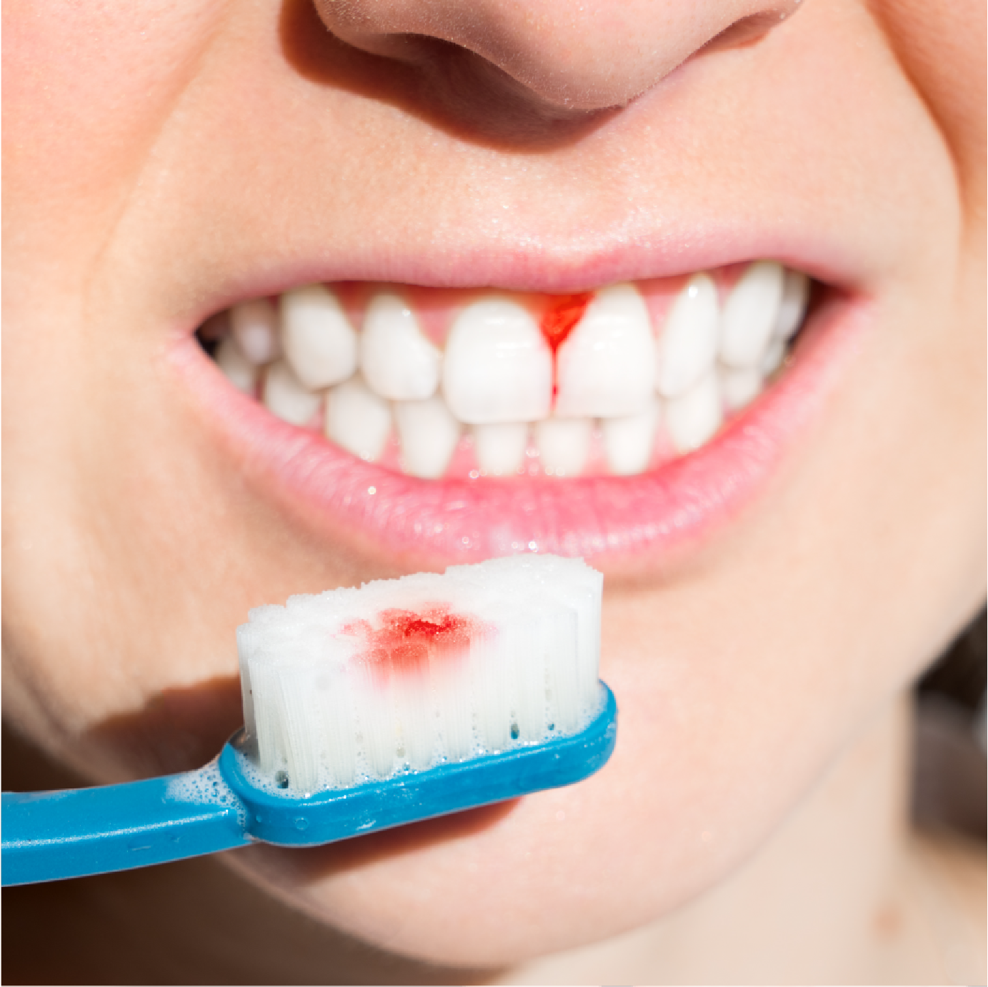 Bleeding Gums While Brushing: Causes Explained and Proper Remedies