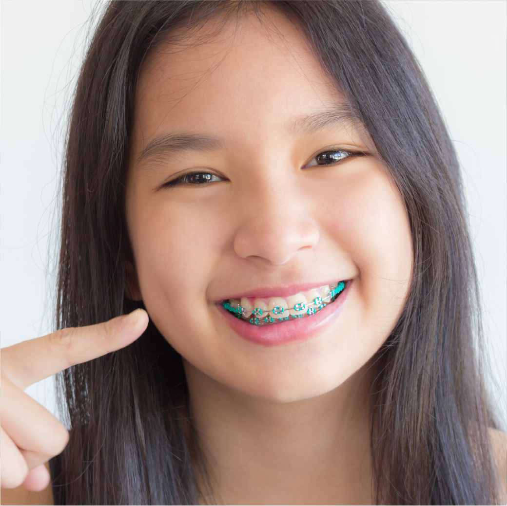 How Long Should You Wear a Retainer After Braces Types Costs and Best Wearing Period