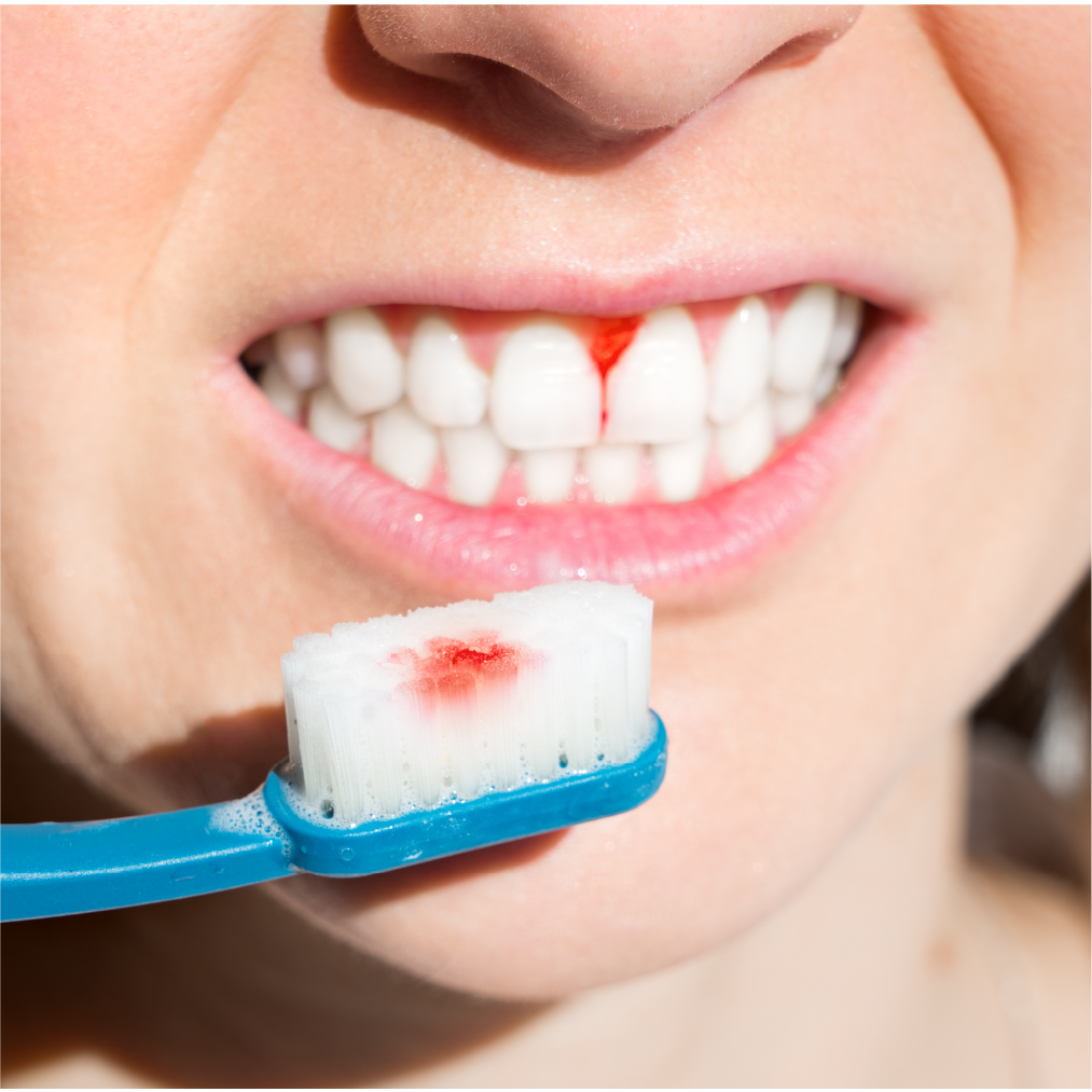 Bleeding Gums: Causes, Treatment, and Prevention