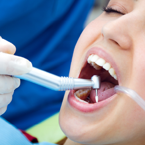 Deep Teeth Cleaning Explained Process Benefits and Suitable Candidates